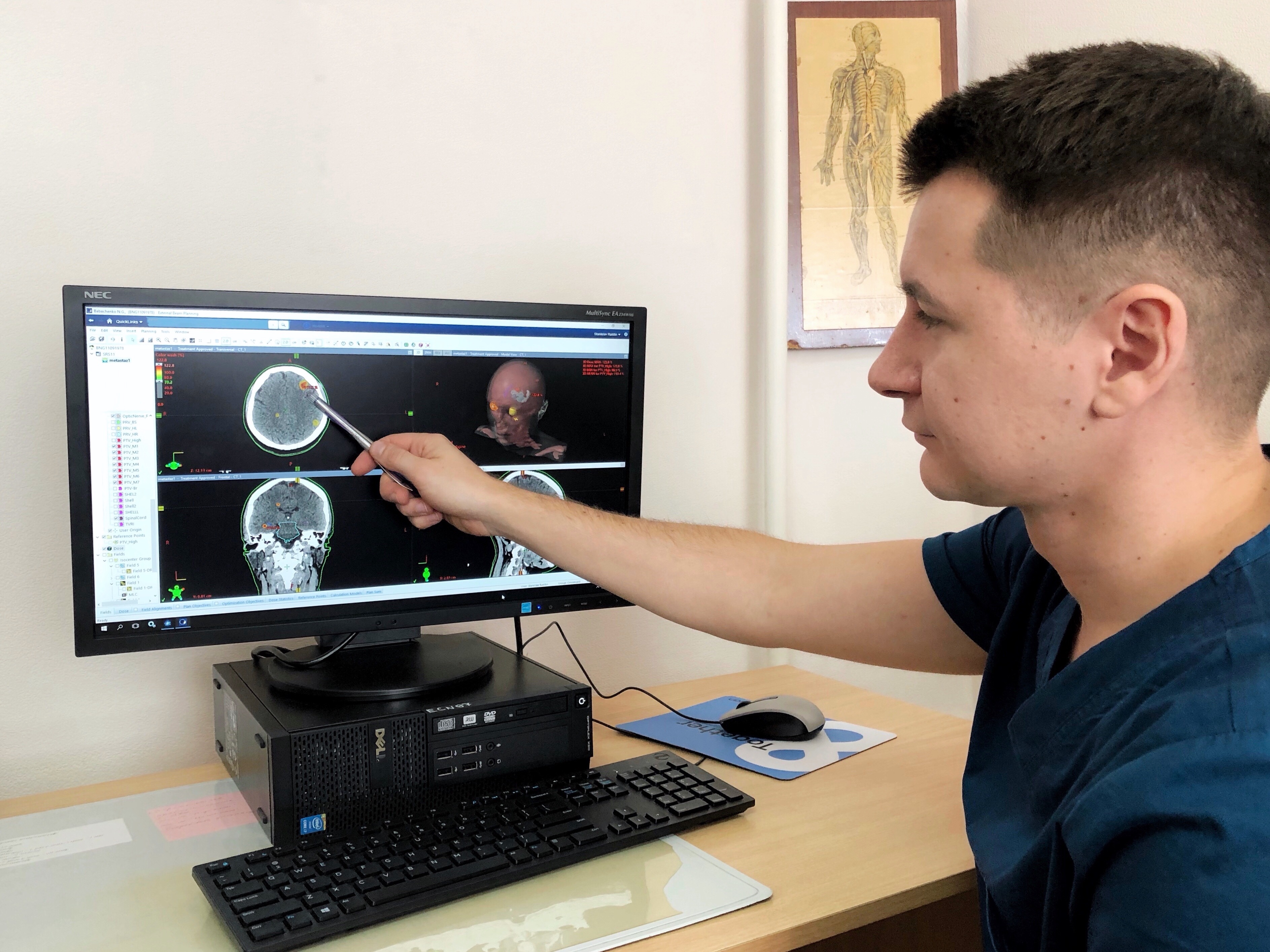 Тюменские радиотерапевты применяют современные технологии в лечении метастатических опухолей головного мозга