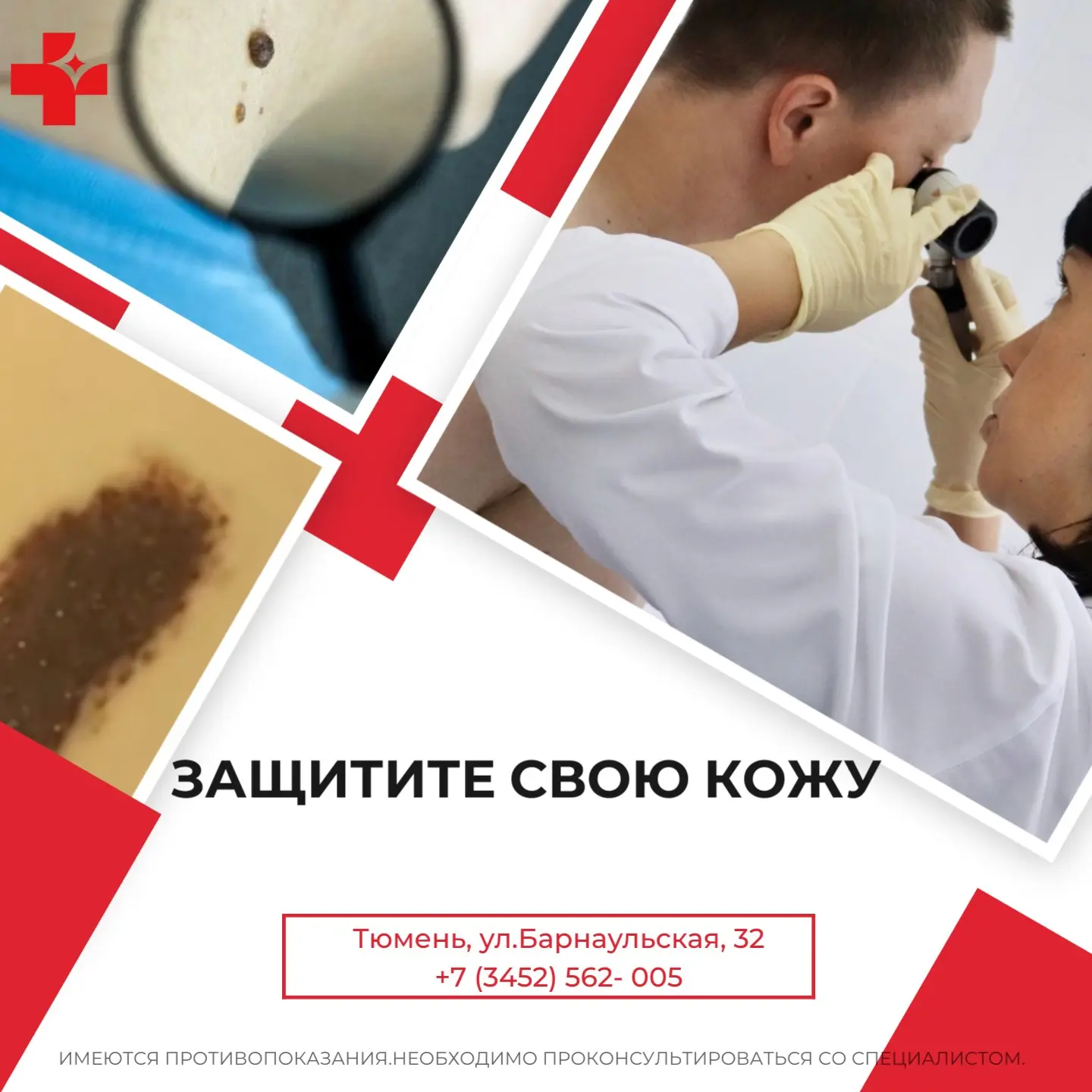 Защитите свою кожу: почему важно знать о базалиоме