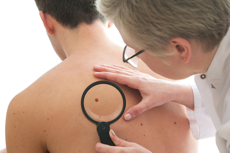 Мифы об онкологии: рак кожи 