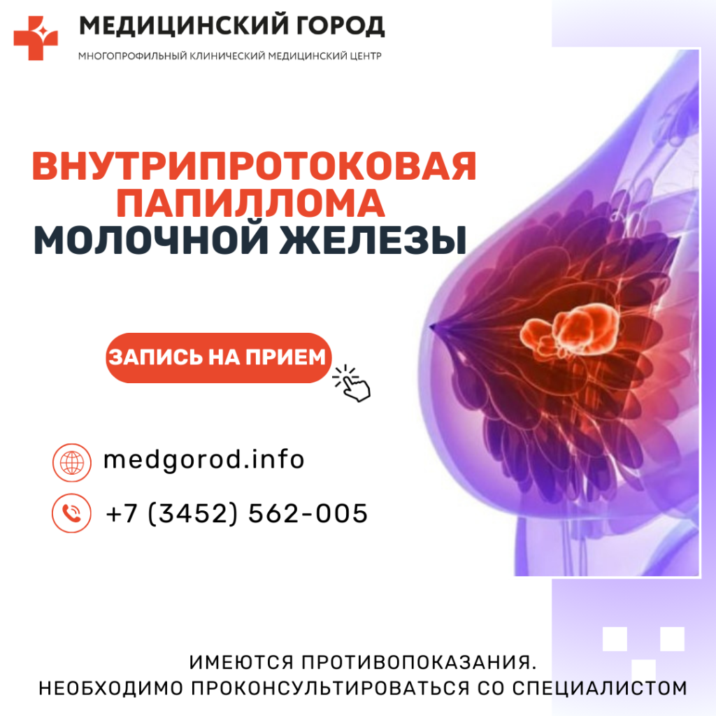 Внутрипротоковая папиллома молочной железы