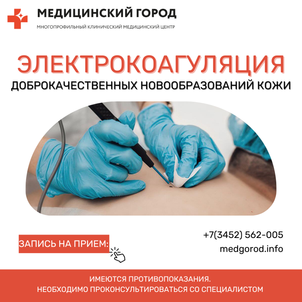 Электрокоагуляция доброкачественных новообразований кожи